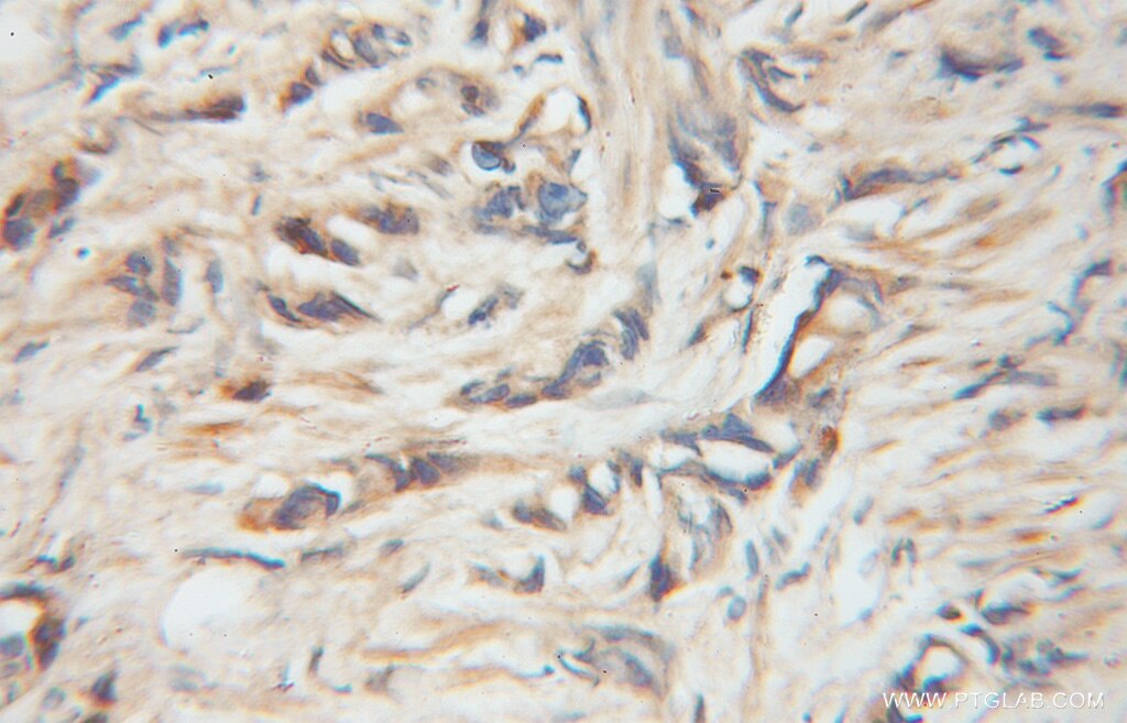 Immunohistochemistry of paraffin-embedded human prostate cancer using 11667-1-AP(NFATC2IP Antibody) at Dilution 1:50 (under 10x lens) NFATC2IP IHC Immunohistochemical 11667-1-AP NFATC2IP Antibody FLJ14639; MGC126790; MGC138387