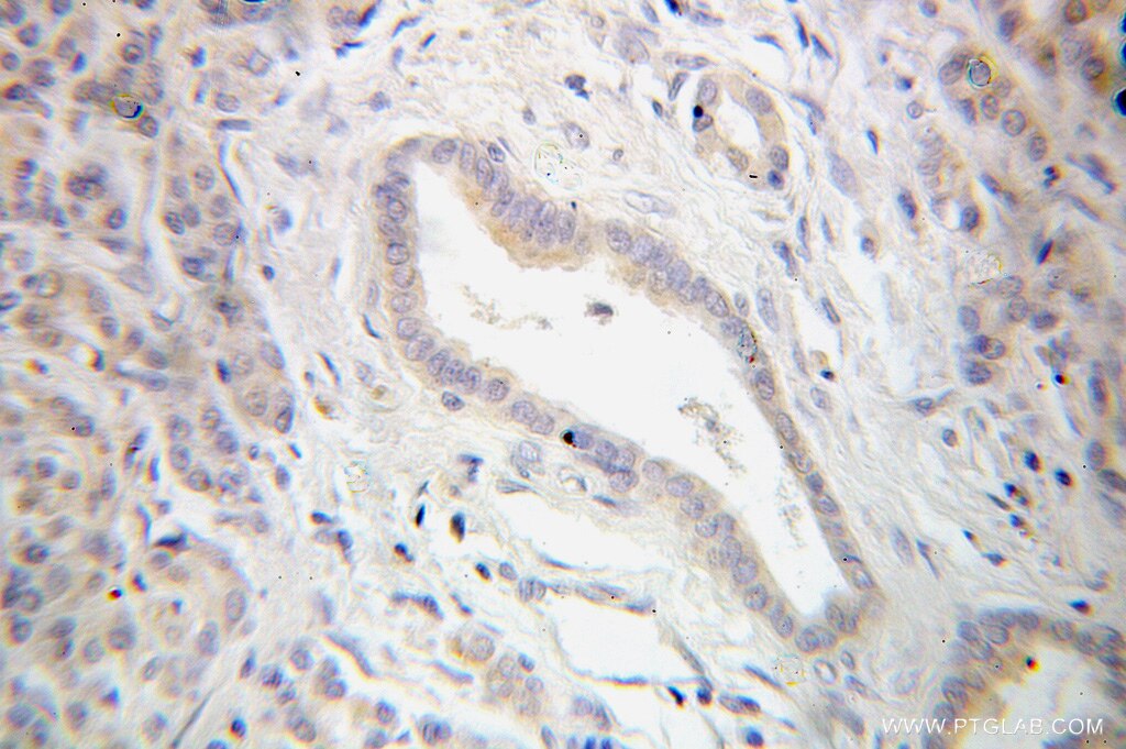 Immunohistochemistry of paraffin-embedded human pancreas cancer using 10409-2-AP(NFKB2 Antibody) at Dilution 1:50 (under 25x lens) NFKB2 IHC Immunohistochemical 10409-2-AP NFKB2 Antibody LYT-10; LYT10