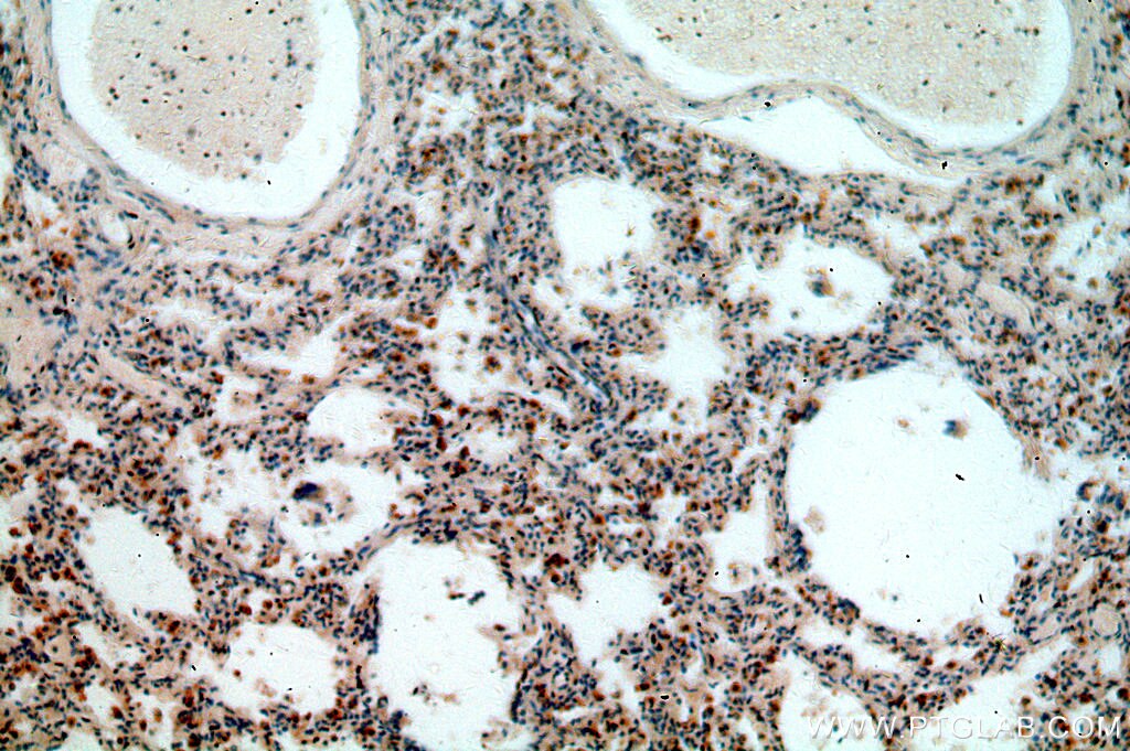 NOTCH1 IHC Immunohistochemical 20687-1-AP NOTCH1 Antibody TAN1; hN1