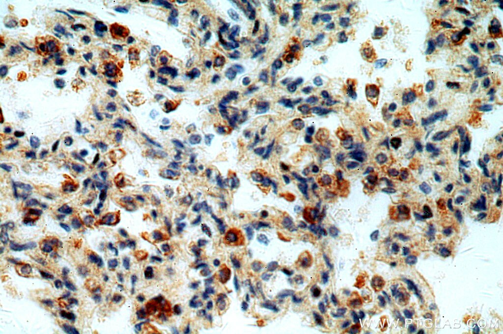 NOTCH1 IHC Immunohistochemical 20687-1-AP NOTCH1 Antibody TAN1; hN1