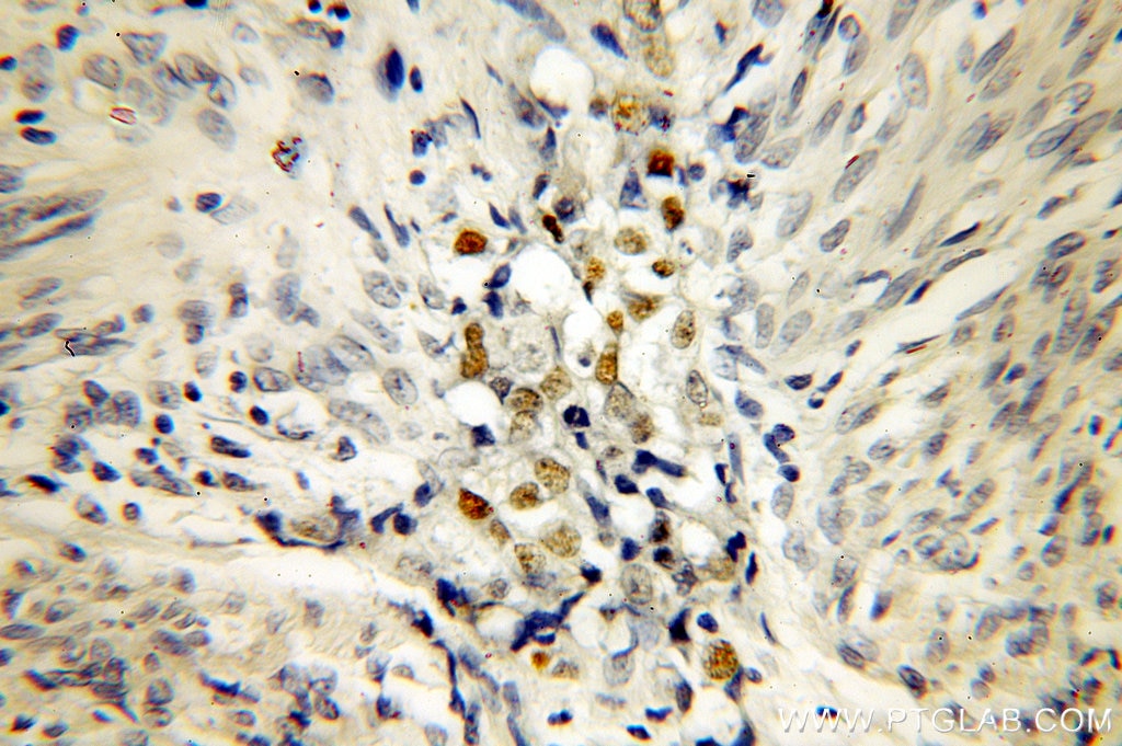 P53 IHC Immunohistochemical 10442-1-AP P53 Antibody FLJ92943; LFS1; TRP53; p53