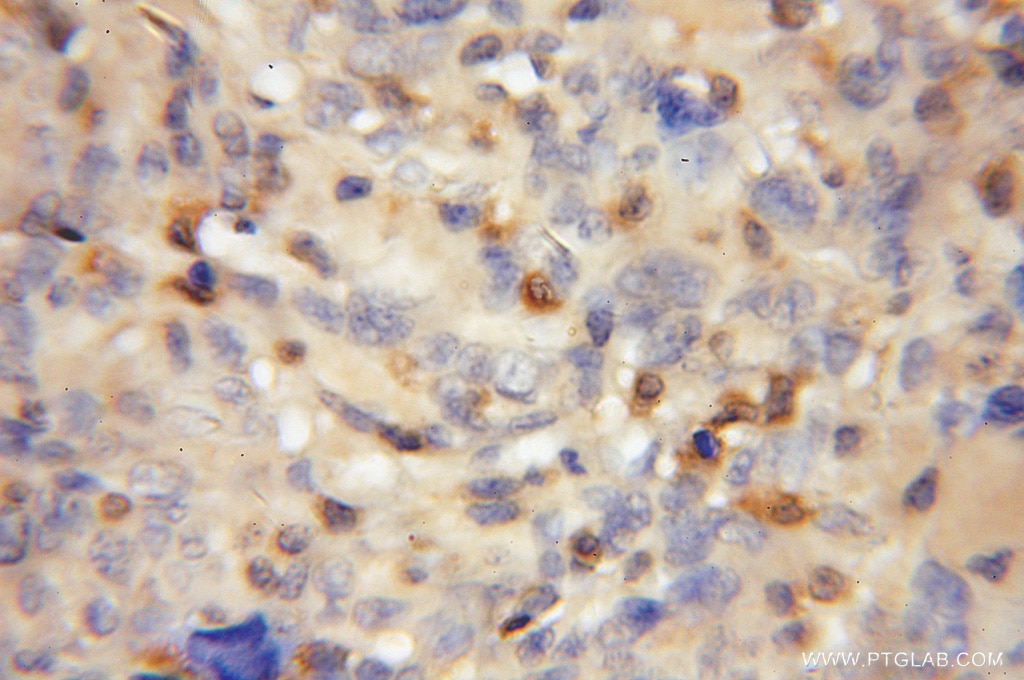 Immunohistochemistry of paraffin-embedded human gliomas using 12110-1-AP(PADI2 Antibody) at Dilution 1:50 (under 10x lens) PADI2 IHC Immunohistochemical 12110-1-AP PADI2 Antibody KIAA0994; PAD-H19; PAD2; PDI2