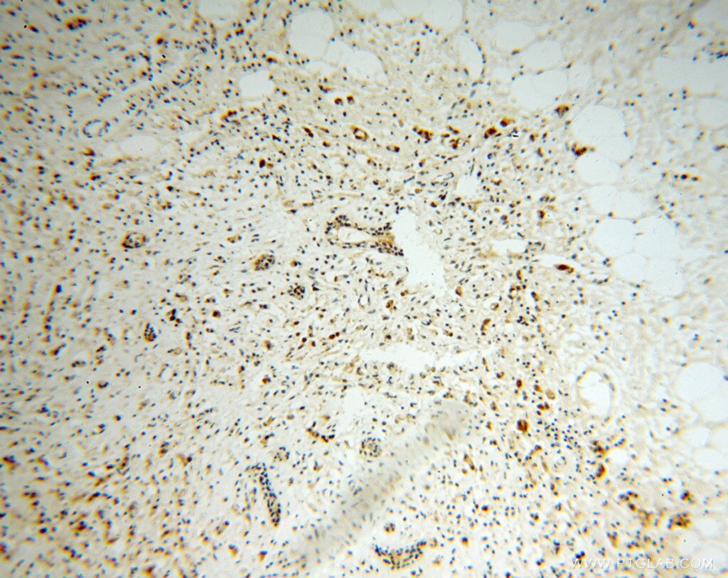 Immunohistochemistry of paraffin-embedded human breast cancer using PCNA Antibody 10205-2-AP (under 10x lens) PCNA IHC Immunohistochemistry 10205-2-AP PCNA Antibody MGC8367
