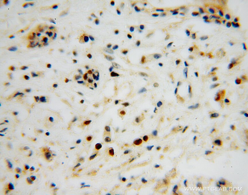 Immunohistochemistry of paraffin-embedded human breast cancer using PCNA Antibody 10205-2-AP (under 40x lens) PCNA IHC Immunohistochemistry 10205-2-AP PCNA Antibody MGC8367