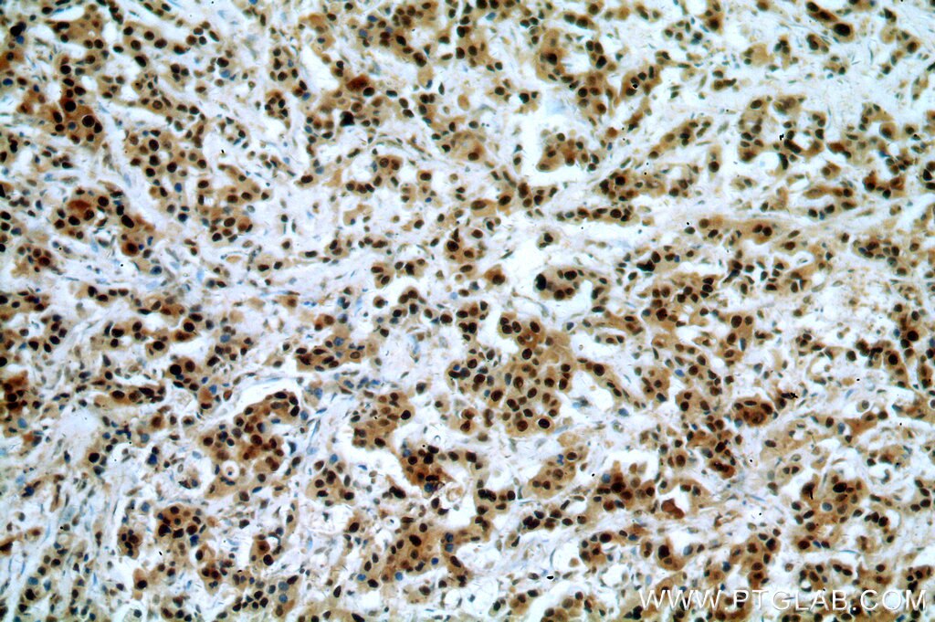 Immunohistochemistry of paraffin-embedded human breast cancer using PCNA Antibody 10205-2-AP (under 10x lens) PCNA IHC Immunohistochemistry 10205-2-AP PCNA Antibody MGC8367