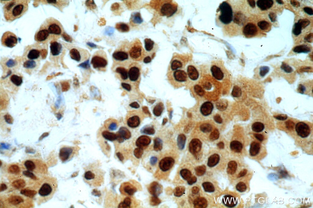 Immunohistochemistry of paraffin-embedded human breast cancer using PCNA Antibody 10205-2-AP (under 40x lens) PCNA IHC Immunohistochemistry 10205-2-AP PCNA Antibody MGC8367