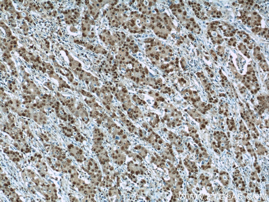 Immunohistochemistry of paraffin-embedded human stomach cancer using PCNA Antibody 10205-2-AP (under 10x lens) PCNA IHC Immunohistochemistry 10205-2-AP PCNA Antibody MGC8367