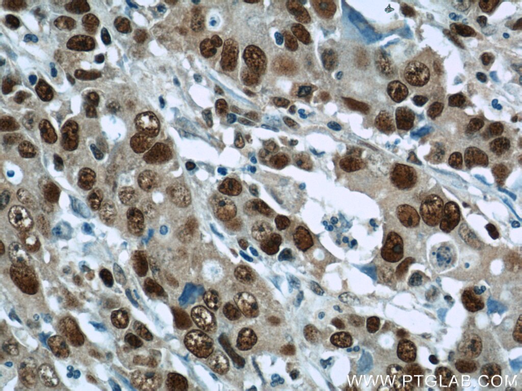 Immunohistochemistry of paraffin-embedded human stomach cancer using PCNA Antibody 10205-2-AP (under 40x lens) PCNA IHC Immunohistochemistry 10205-2-AP PCNA Antibody MGC8367