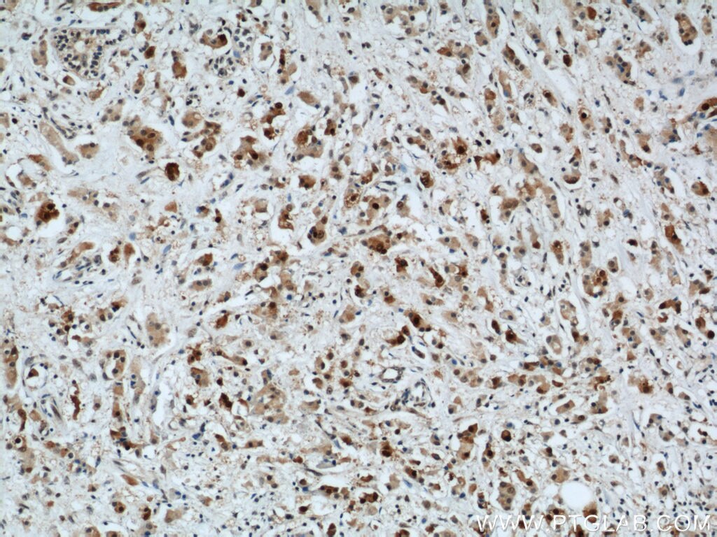 Immunohistochemistry of paraffin-embedded human breast cancer using PCNA Antibody 10205-2-AP (under 10x lens) PCNA IHC Immunohistochemistry 10205-2-AP PCNA Antibody MGC8367
