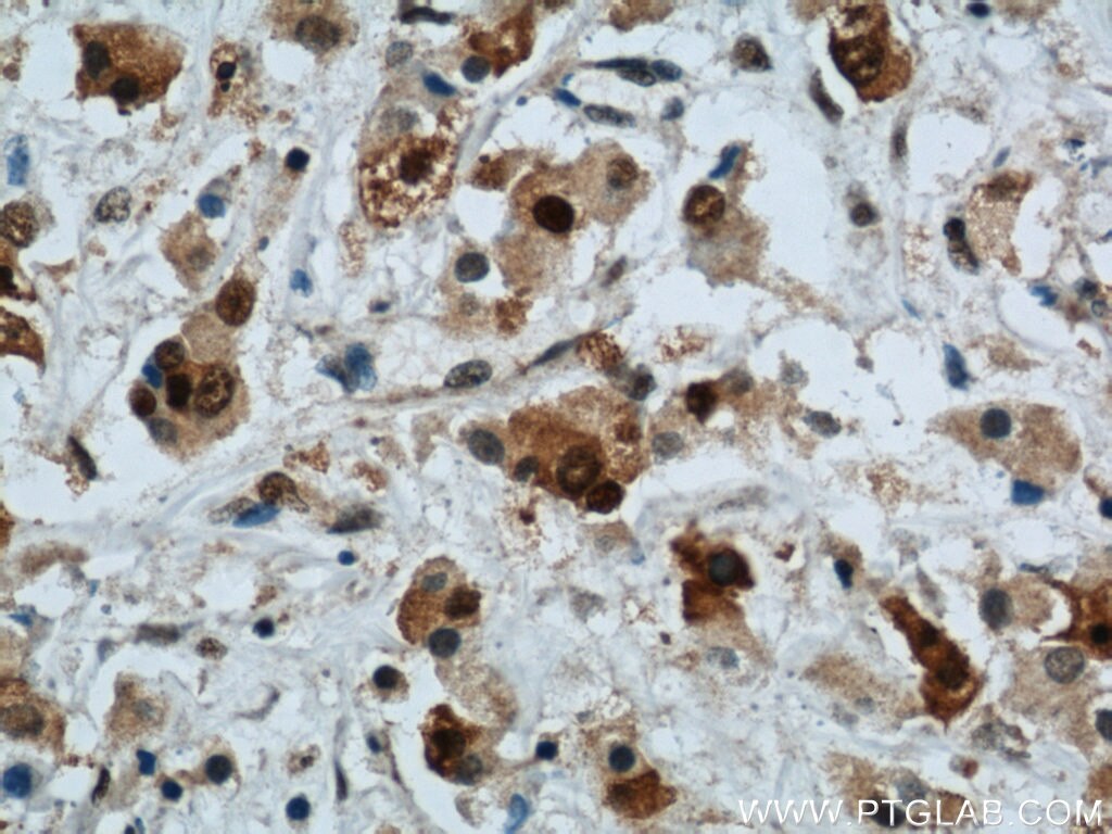 Immunohistochemistry of paraffin-embedded human breast cancer using PCNA Antibody 10205-2-AP (under 40x lens) PCNA IHC Immunohistochemistry 10205-2-AP PCNA Antibody MGC8367