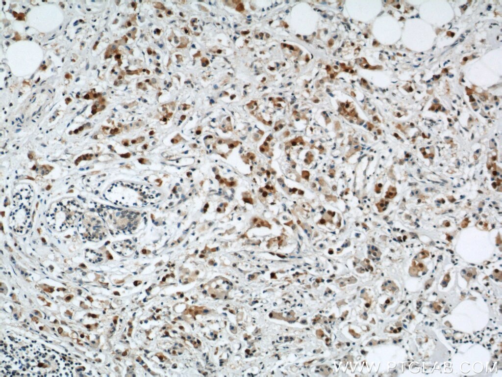 Immunohistochemistry of paraffin-embedded human breast cancer using PCNA Antibody 10205-2-AP (under 10x lens) PCNA IHC Immunohistochemistry 10205-2-AP PCNA Antibody MGC8367