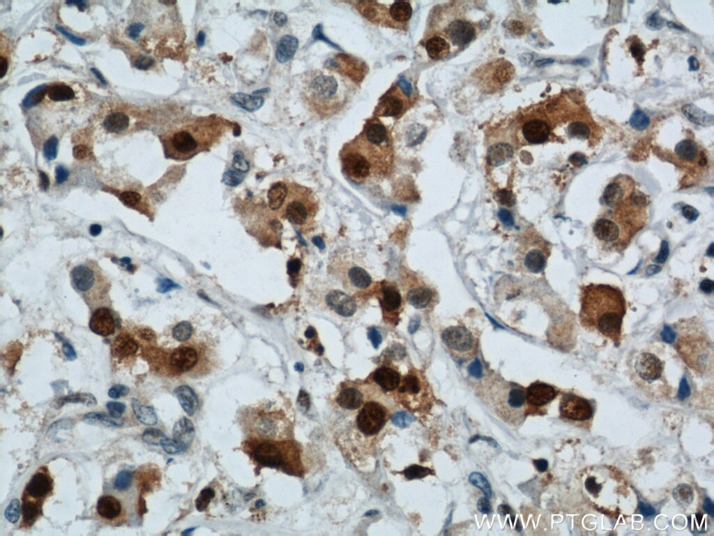 Immunohistochemistry of paraffin-embedded human breast cancer using PCNA Antibody 10205-2-AP (under 40x lens) PCNA IHC Immunohistochemistry 10205-2-AP PCNA Antibody MGC8367
