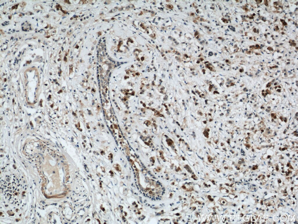 Immunohistochemistry of paraffin-embedded human breast cancer using PCNA Antibody 10205-2-AP (under 10x lens) PCNA IHC Immunohistochemistry 10205-2-AP PCNA Antibody MGC8367