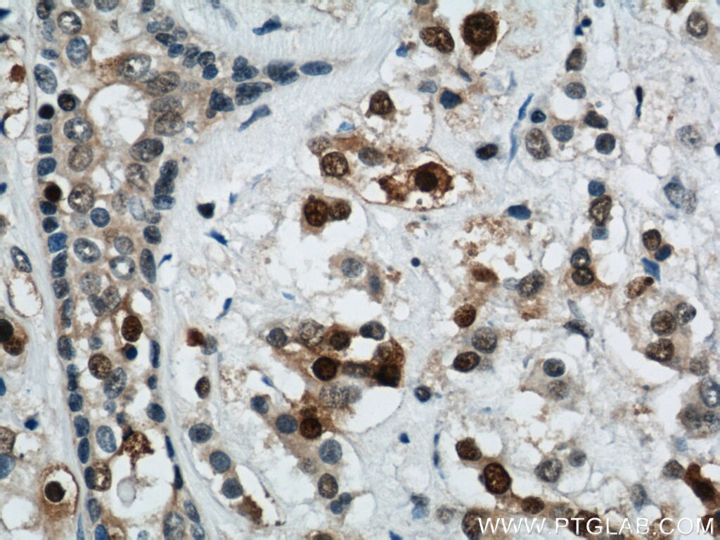 Immunohistochemistry of paraffin-embedded human breast cancer using PCNA Antibody 10205-2-AP (under 40x lens) PCNA IHC Immunohistochemistry 10205-2-AP PCNA Antibody MGC8367
