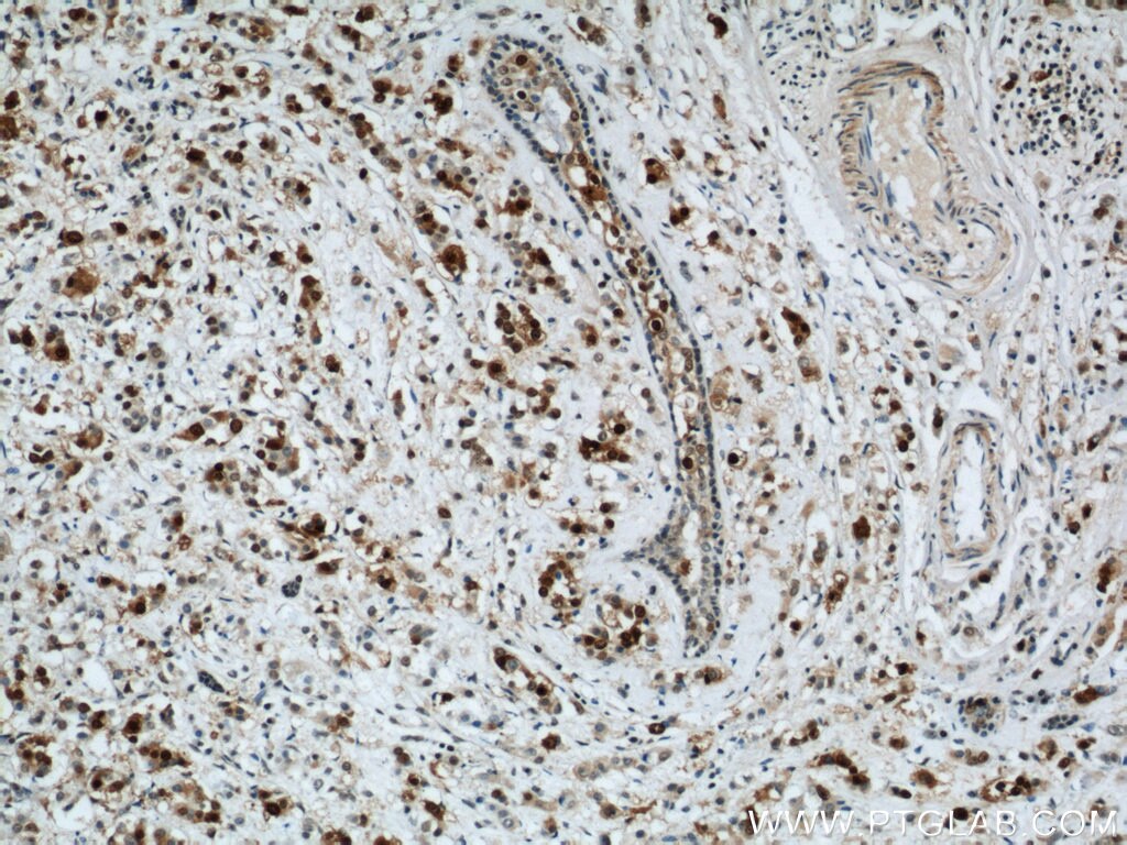 Immunohistochemistry of paraffin-embedded human breast cancer using PCNA Antibody 10205-2-AP (under 10x lens) PCNA IHC Immunohistochemistry 10205-2-AP PCNA Antibody MGC8367