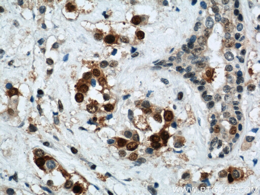 Immunohistochemistry of paraffin-embedded human breast cancer using PCNA Antibody 10205-2-AP (under 40x lens) PCNA IHC Immunohistochemistry 10205-2-AP PCNA Antibody MGC8367