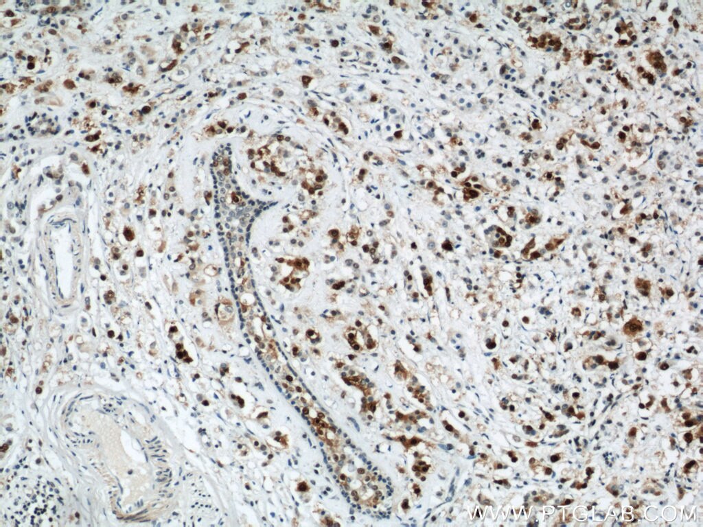 Immunohistochemistry of paraffin-embedded human breast cancer using PCNA Antibody 10205-2-AP (under 10x lens) PCNA IHC Immunohistochemistry 10205-2-AP PCNA Antibody MGC8367