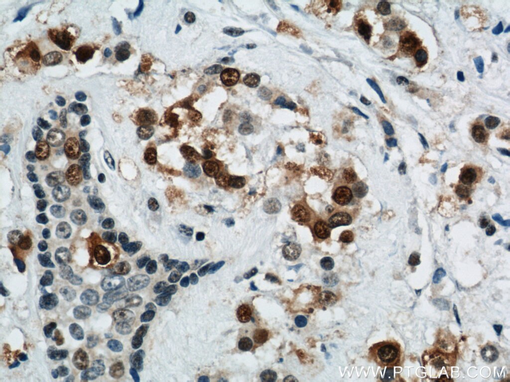 Immunohistochemistry of paraffin-embedded human breast cancer using PCNA Antibody 10205-2-AP (under 40x lens) PCNA IHC Immunohistochemistry 10205-2-AP PCNA Antibody MGC8367