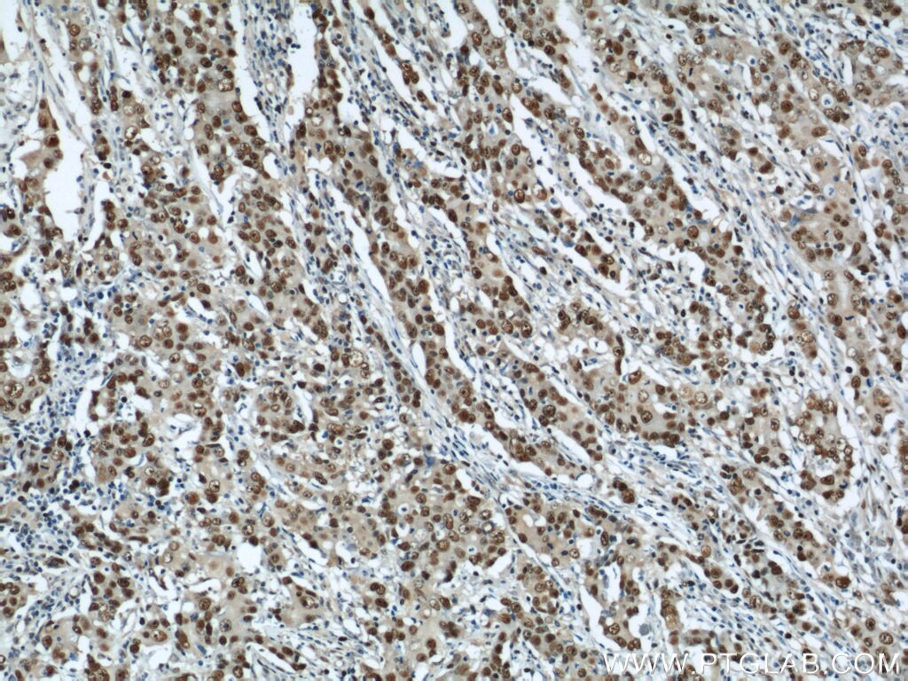 Immunohistochemistry of paraffin-embedded human stomach cancer using PCNA Antibody 10205-2-AP (under 10x lens) PCNA IHC Immunohistochemistry 10205-2-AP PCNA Antibody MGC8367