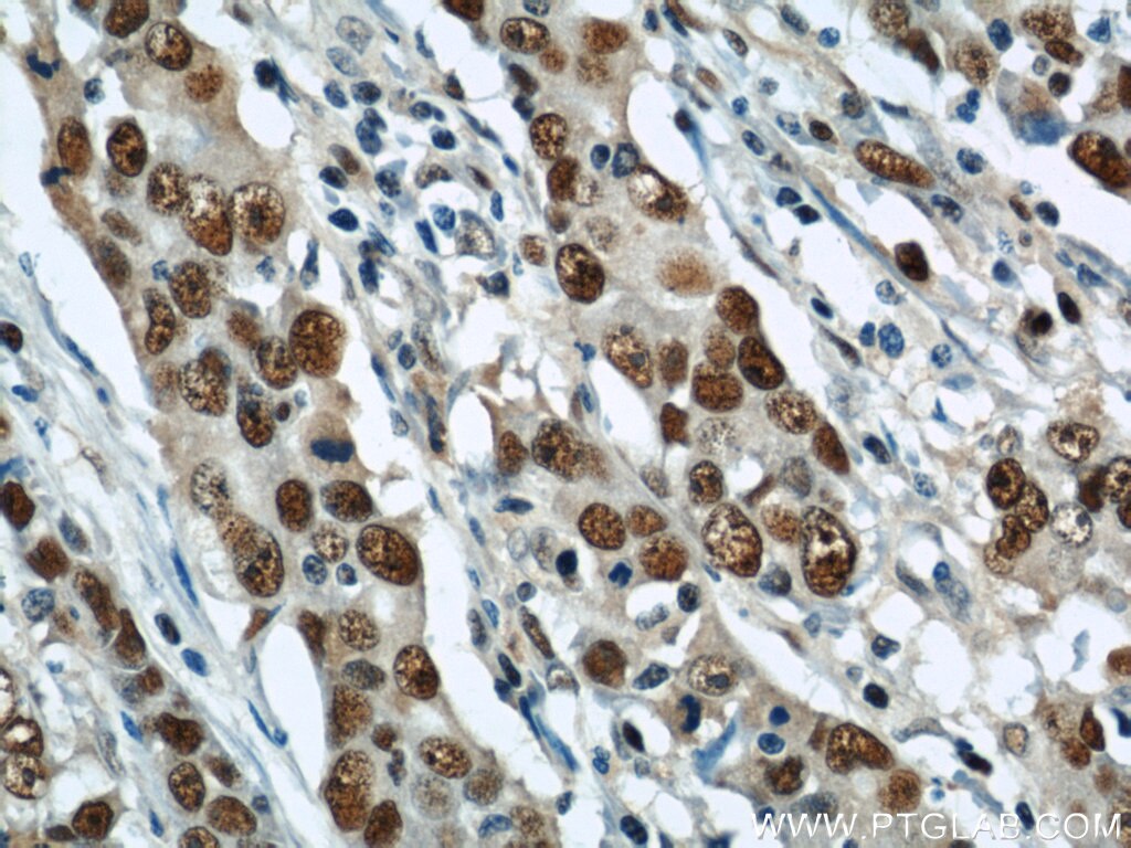 Immunohistochemistry of paraffin-embedded human stomach cancer using PCNA Antibody 10205-2-AP (under 40x lens) PCNA IHC Immunohistochemistry 10205-2-AP PCNA Antibody MGC8367