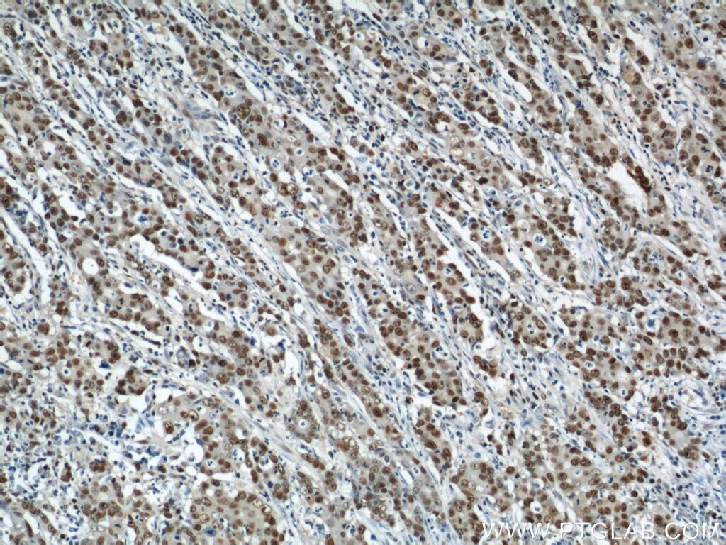 Immunohistochemistry of paraffin-embedded human stomach cancer using PCNA Antibody 10205-2-AP (under 10x lens) PCNA IHC Immunohistochemistry 10205-2-AP PCNA Antibody MGC8367