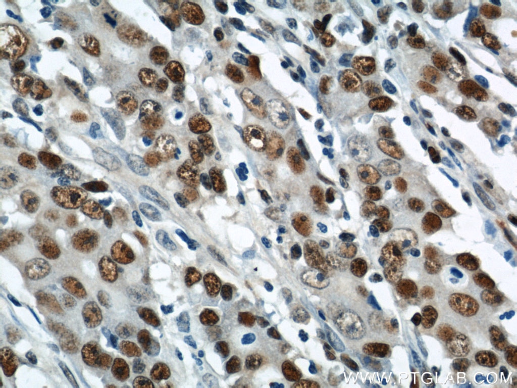 Immunohistochemistry of paraffin-embedded human stomach cancer using PCNA Antibody 10205-2-AP (under 40x lens) PCNA IHC Immunohistochemistry 10205-2-AP PCNA Antibody MGC8367