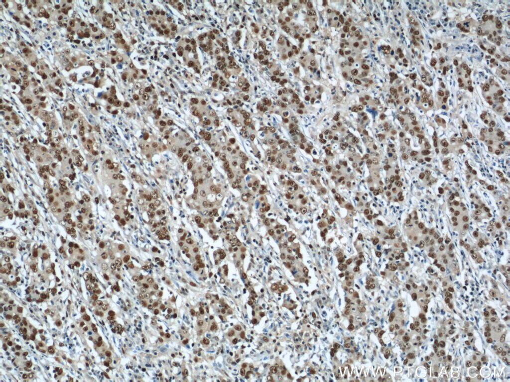 Immunohistochemistry of paraffin-embedded human stomach cancer using PCNA Antibody 10205-2-AP (under 10x lens) PCNA IHC Immunohistochemistry 10205-2-AP PCNA Antibody MGC8367