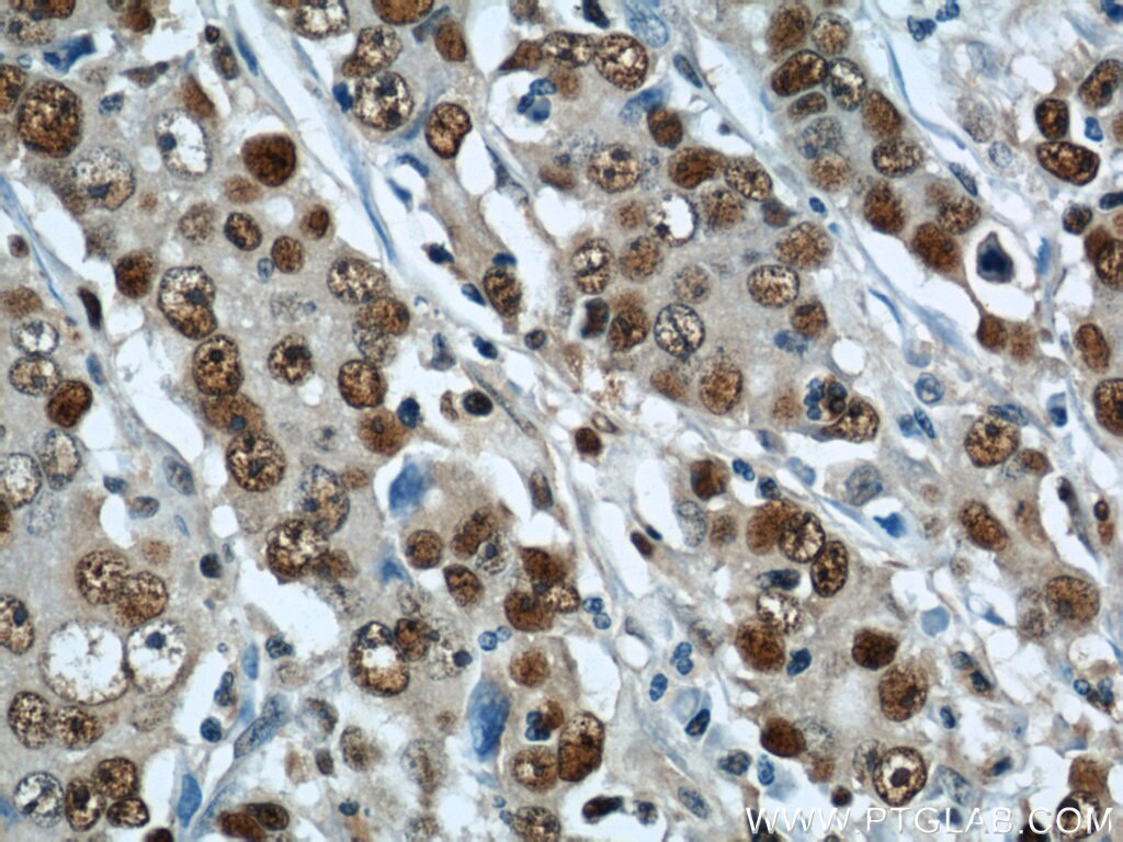 Immunohistochemistry of paraffin-embedded human stomach cancer using PCNA Antibody 10205-2-AP (under 40x lens) PCNA IHC Immunohistochemistry 10205-2-AP PCNA Antibody MGC8367