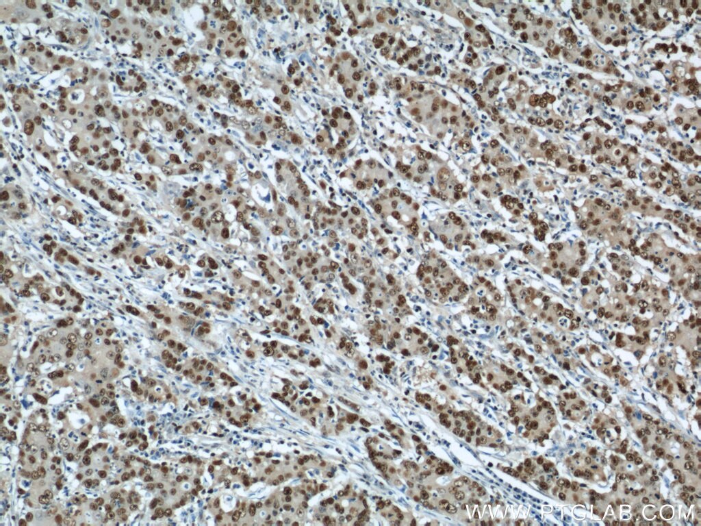 Immunohistochemistry of paraffin-embedded human stomach cancer using PCNA Antibody 10205-2-AP (under 10x lens) PCNA IHC Immunohistochemistry 10205-2-AP PCNA Antibody MGC8367