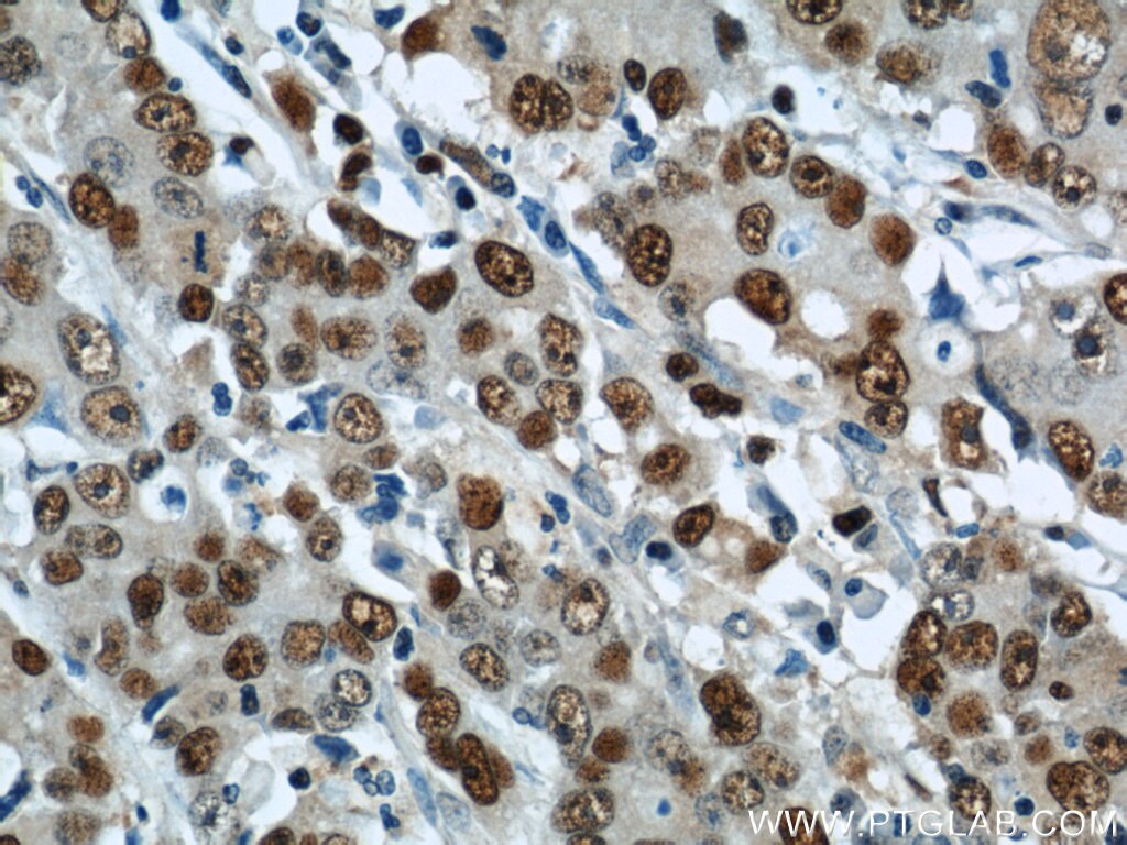 Immunohistochemistry of paraffin-embedded human stomach cancer using PCNA Antibody 10205-2-AP (under 40x lens) PCNA IHC Immunohistochemistry 10205-2-AP PCNA Antibody MGC8367