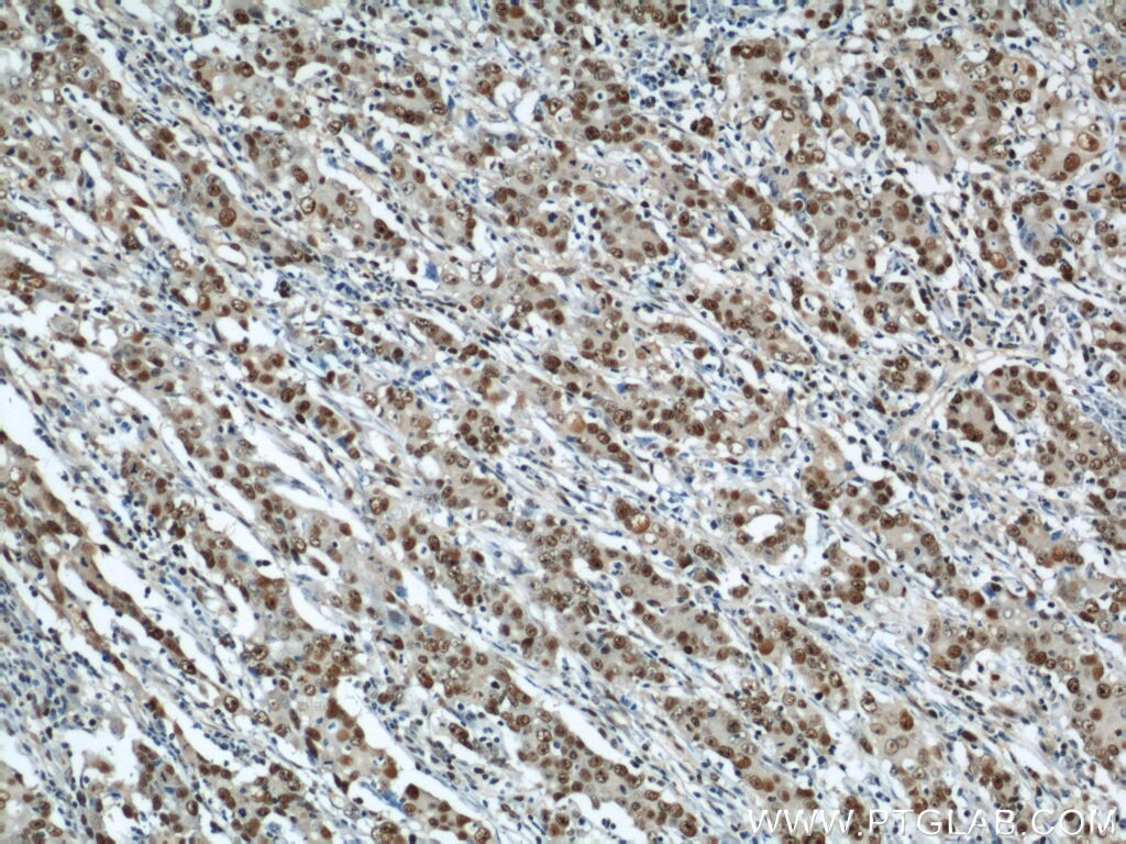 Immunohistochemistry of paraffin-embedded human stomach cancer using PCNA Antibody 10205-2-AP (under 10x lens) PCNA IHC Immunohistochemistry 10205-2-AP PCNA Antibody MGC8367