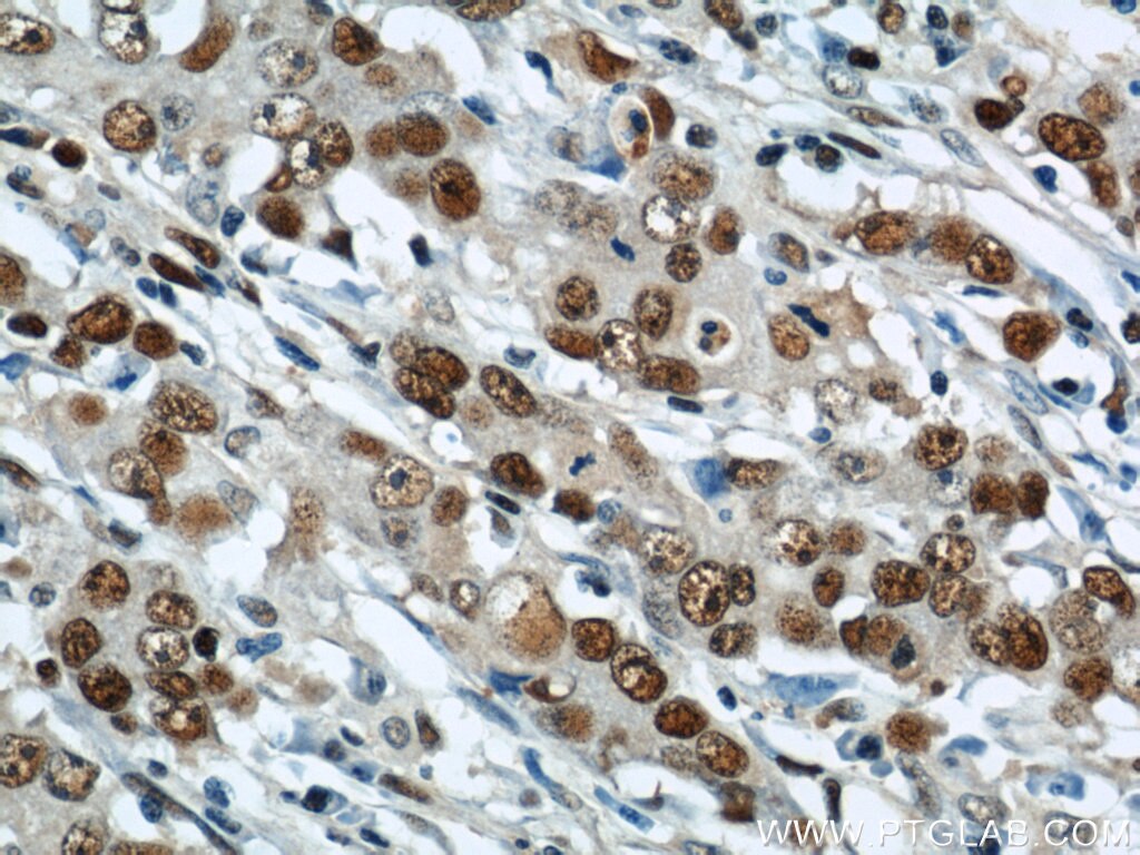 Immunohistochemistry of paraffin-embedded human stomach cancer using PCNA Antibody 10205-2-AP (under 40x lens) PCNA IHC Immunohistochemistry 10205-2-AP PCNA Antibody MGC8367