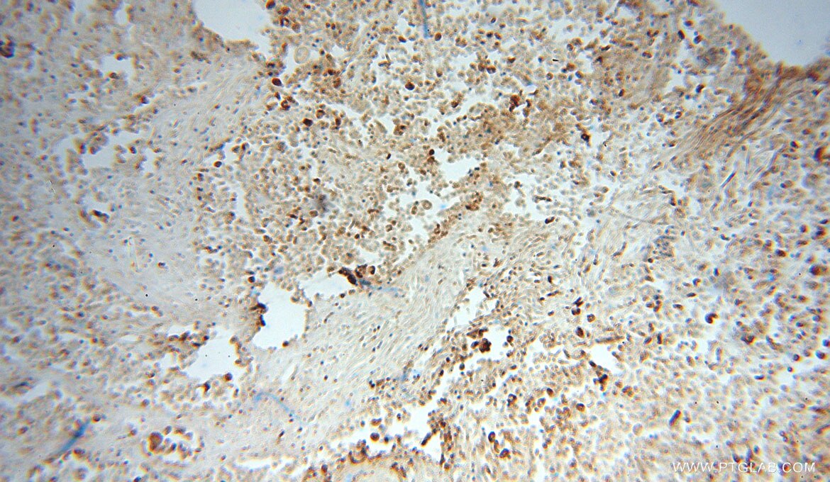 PDIA3 IHC Immunohistochemical 15967-1-AP PDIA3 Antibody PDIA3;ER60;ERp57;ERp60;ERp61;GRP57;GRP58;HsT17083;P58;PI-PLC ;