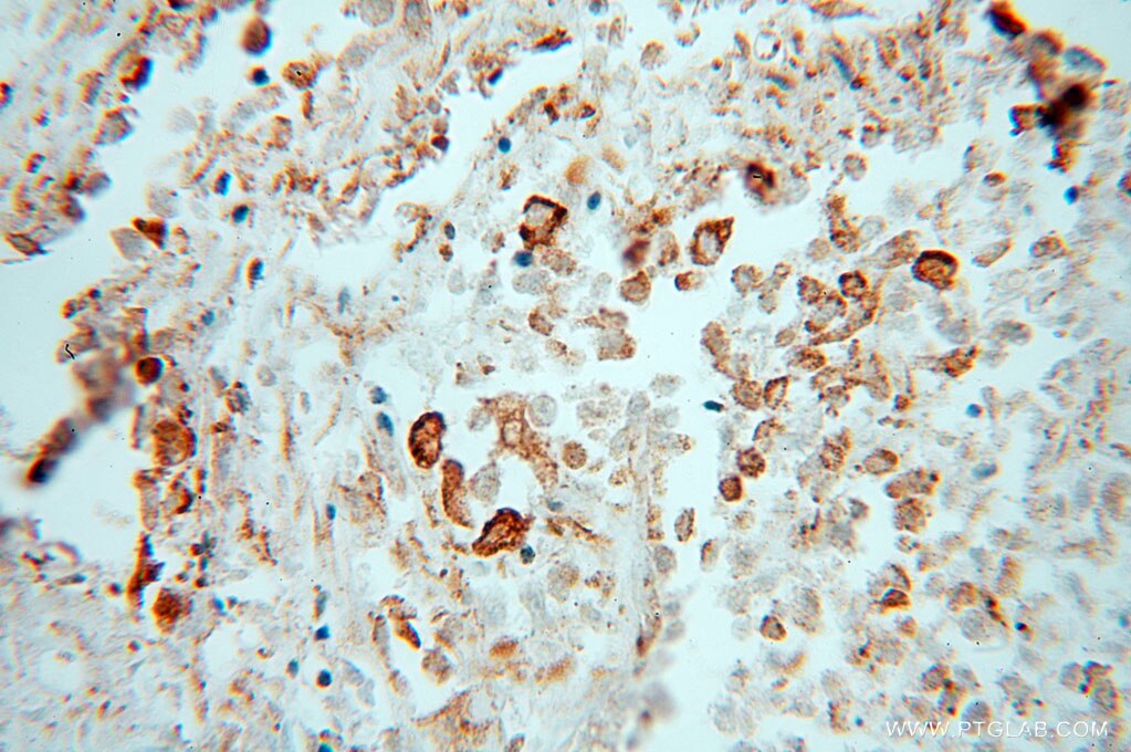 PDIA3 IHC Immunohistochemical 15967-1-AP PDIA3 Antibody PDIA3;ER60;ERp57;ERp60;ERp61;GRP57;GRP58;HsT17083;P58;PI-PLC ;