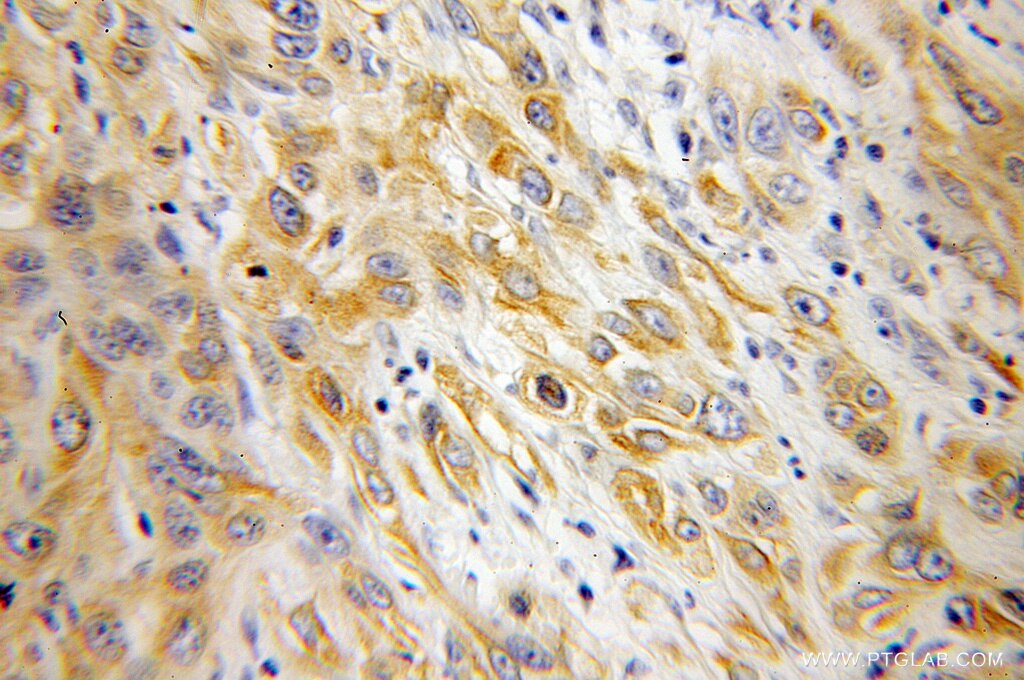 Immunohistochemistry of paraffin-embedded human cervical cancer using 12990-1-AP(PGRMC1 Antibody) at Dilution 1:100 (under 10x lens) PGRMC1 IHC Immunohistochemical 12990-1-AP PGRMC1 Antibody HPR6.6; MPR