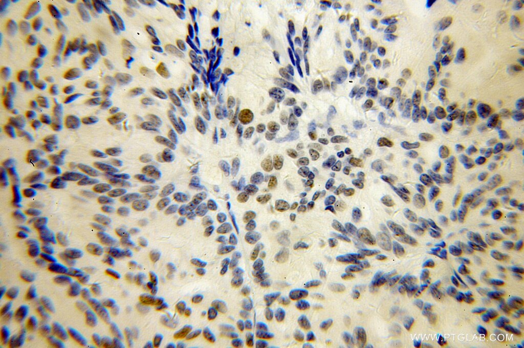 PHF6 IHC Immunohistochemical 51062-1-AP PHF6 Antibody BORJ; MGC14797