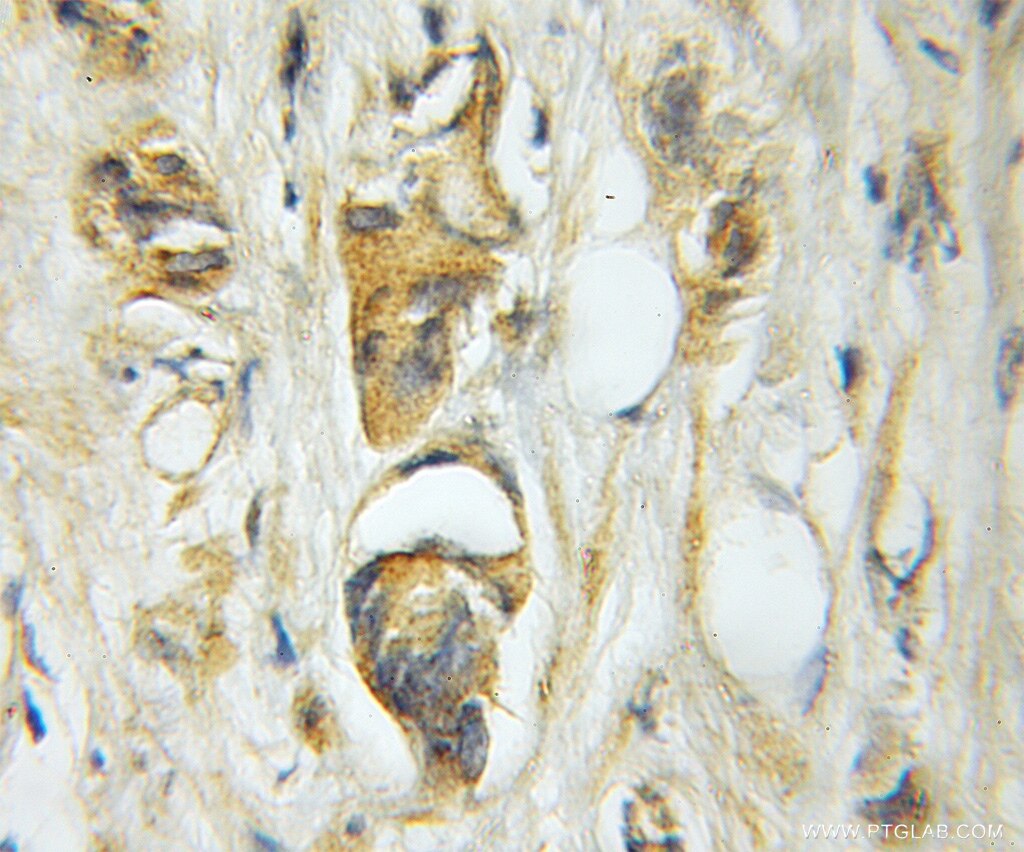 Immunohistochemistry of paraffin-embedded human prostate cancer using 11748-1-AP(PIK3R1 Antibody) at Dilution 1:50 (under 10x lens) PIK3R1 IHC Immunohistochemical 11748-1-AP PIK3R1 Antibody GRB1; p85; p85-ALPHA