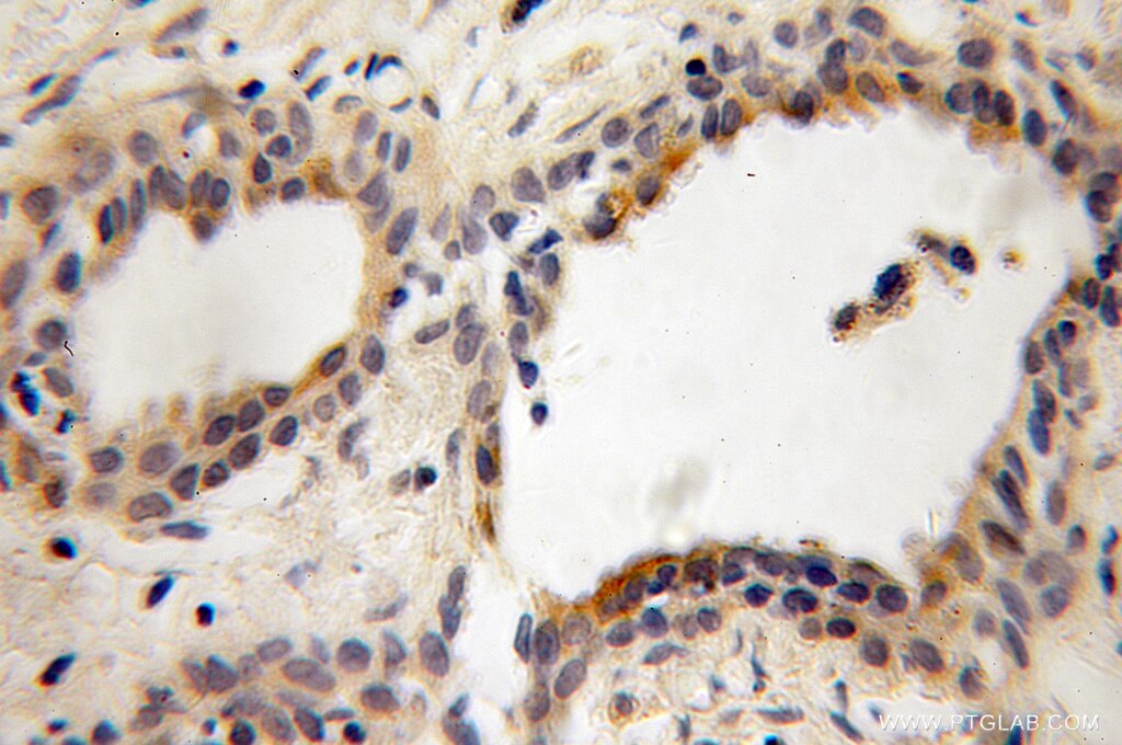 Immunohistochemistry of paraffin-embedded human prostate cancer using 13110-1-AP(PITPNB Antibody) at Dilution 1:100 (under 10x lens) PITPNB IHC Immunohistochemical 13110-1-AP PITPNB Antibody PI-TP-beta; PtdInsTP; VIB1B