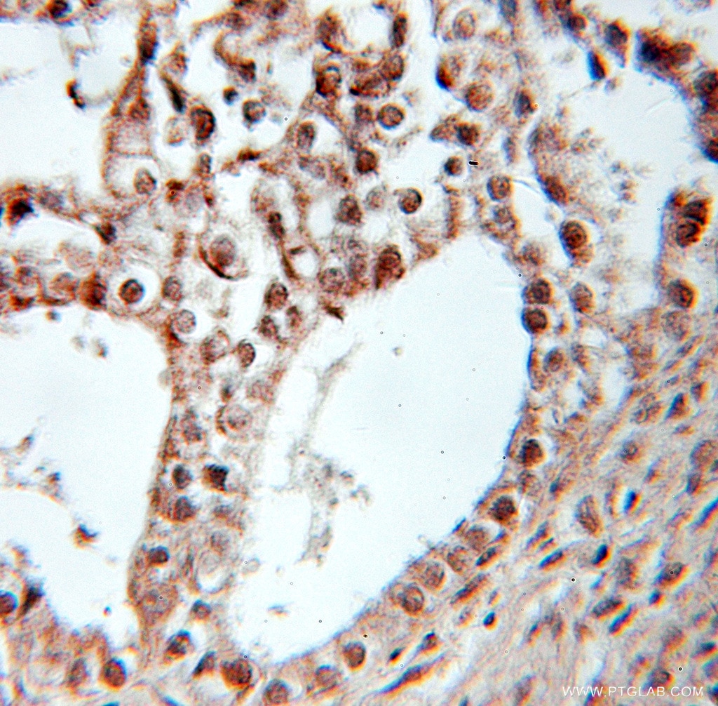 Immunohistochemistry of paraffin-embedded human ovary tumor using 10156-2-AP(PPARD Antibody) at Dilution 1:10 (under 10x lens) PPARD IHC Immunohistochemical 10156-2-AP PPARD Antibody FAAR; MGC3931; NR1C2; NUC1; NUCI; NUCII; PPAR-beta; PPARB