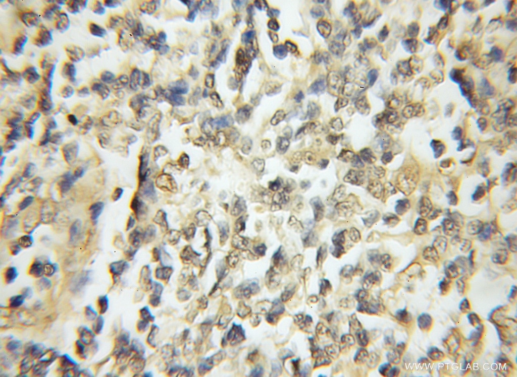 Immunohistochemistry of paraffin-embedded human lymphoma using 11887-1-AP(PSMA3 Antibody) at Dilution 1:50 (under 10x lens) PSMA3 IHC Immunohistochemical 11887-1-AP PSMA3 Antibody HC8; MGC12306; MGC32631; PSC3