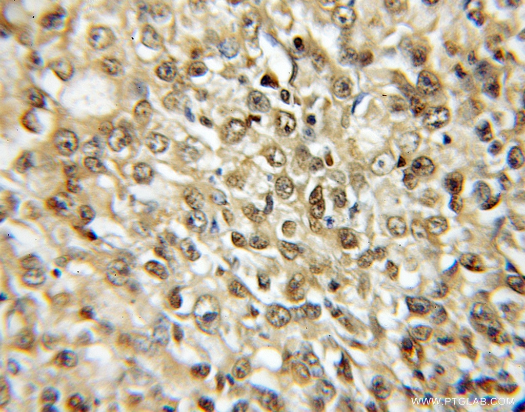 Immunohistochemistry of paraffin-embedded human lung cancer using 11573-1-AP(PSMA6 Antibody) at Dilution 1:50 (under 10x lens) PSMA6 IHC Immunohistochemical 11573-1-AP PSMA6 Antibody IOTA; MGC22756; MGC2333; MGC23846; PROS27; p27K