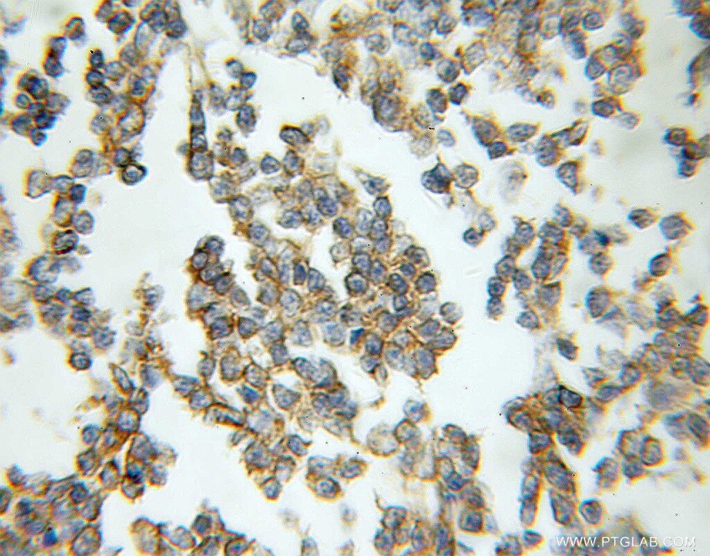 Immunohistochemistry of paraffin-embedded human lymphoma using 11025-1-AP(RAB33A Antibody) at Dilution 1:50 (under 10x lens) RAB33A IHC Immunohistochemical 11025-1-AP RAB33A Antibody MGC1488; RabS10
