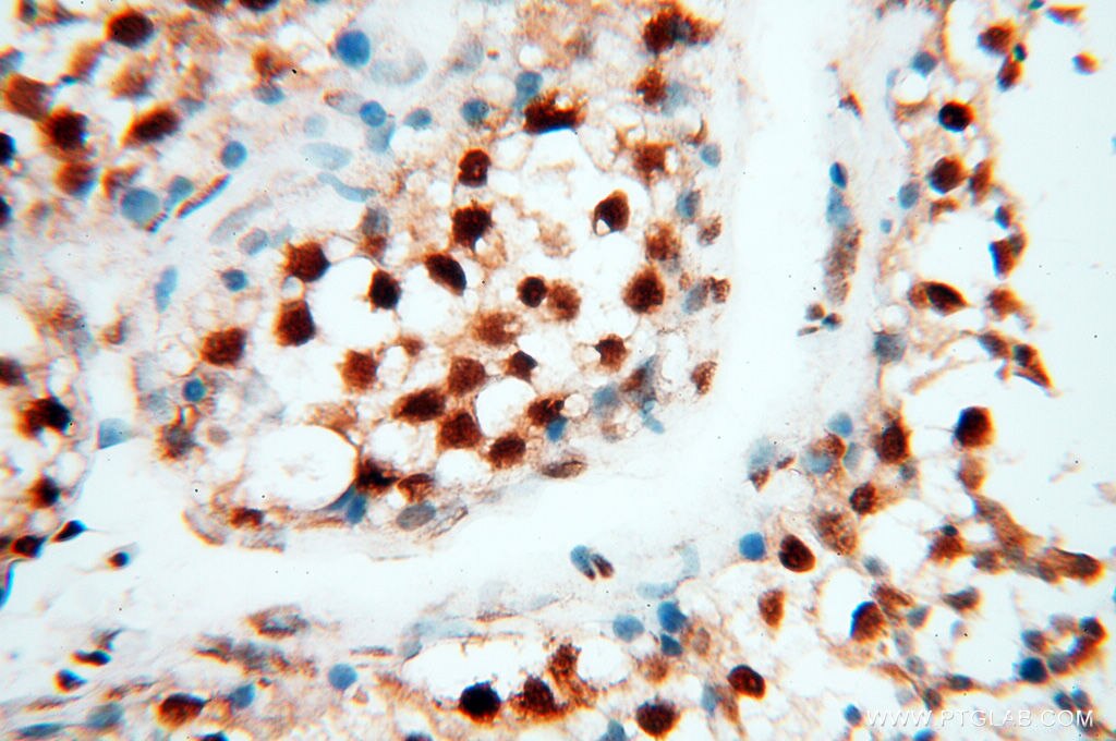 RBM3 IHC Immunohistochemical 14363-1-AP RBM3 Antibody IS1-RNPL; RNPL