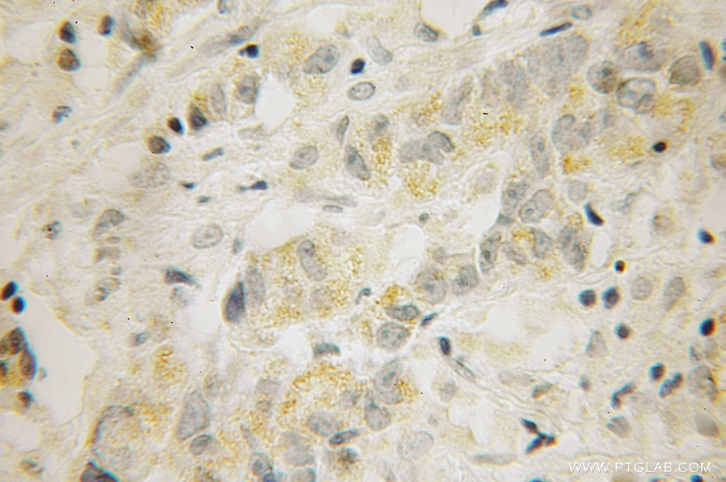 Immunohistochemistry of paraffin-embedded human prostate cancer using 12779-1-AP(RIC3 Antibody) at Dilution 1:100 (under 10x lens) RIC3 IHC Immunohistochemical 12779-1-AP RIC3 Antibody AYST720; FLJ11608; PRO1385