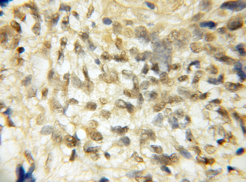 Immunohistochemistry of paraffin-embedded human gliomas using 11982-1-AP(ROBO3 Antibody) at Dilution 1:50 (under 10x lens) ROBO3 IHC Immunohistochemical 11982-1-AP ROBO3 Antibody FLJ21044; HGPPS; HGPS; RBIG1; RIG1