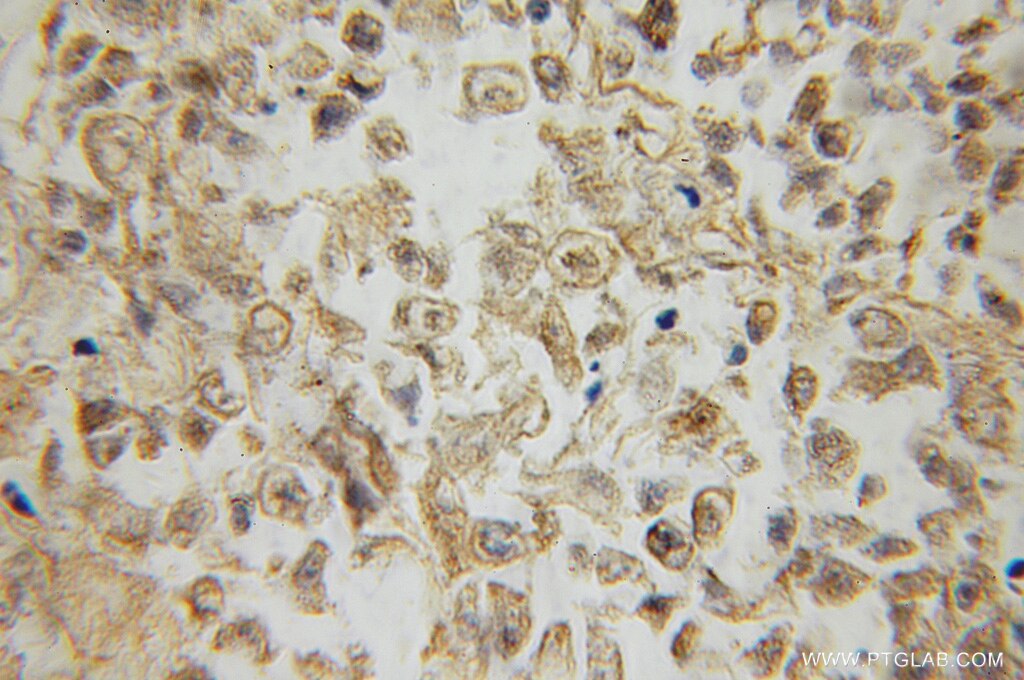 Immunohistochemistry of paraffin-embedded human lung cancer using 12530-1-AP(RRAS2 Antibody) at Dilution 1:50 (under 10x lens) RRAS2 IHC Immunohistochemical 12530-1-AP RRAS2 Antibody TC21
