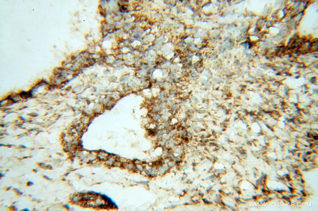 RRM1 IHC Immunohistochemical 10526-1-AP RRM1 Antibody RRM1;R1;RIR1;RR1 ;
