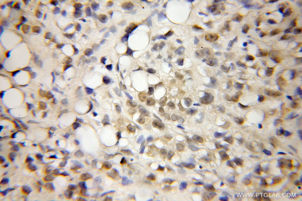 Immunohistochemistry of paraffin-embedded human prostate cancer using 12170-1-AP(RTF1 Antibody) at Dilution 1:50 (under 10x lens) RTF1 IHC Immunohistochemical 12170-1-AP RTF1 Antibody CDG1N; GTL7; KIAA0252