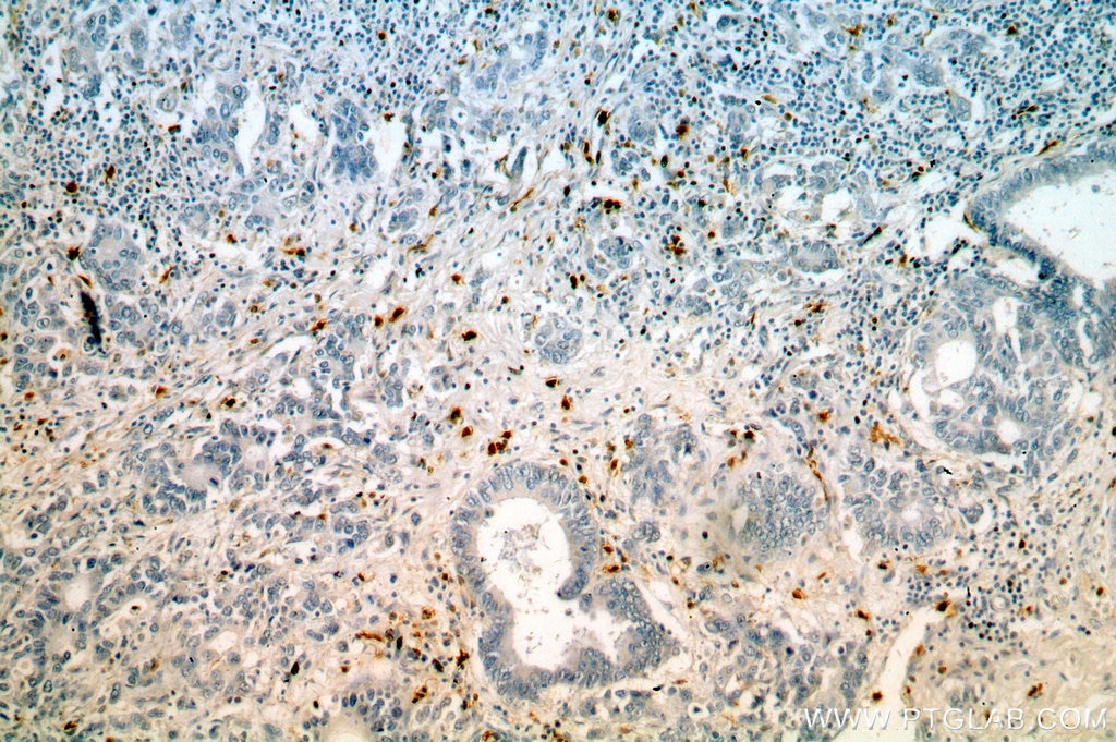 S100A8 IHC Immunohistochemical 15792-1-AP S100A8 Antibody 60B8AG; CAGA; CFAG; CGLA; CP-10; L1Ag; MA387; MIF; MRP8; NIF; P8