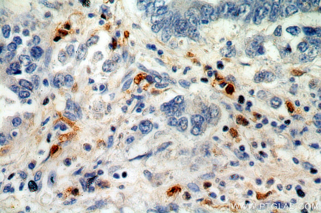 S100A8 IHC Immunohistochemical 15792-1-AP S100A8 Antibody 60B8AG; CAGA; CFAG; CGLA; CP-10; L1Ag; MA387; MIF; MRP8; NIF; P8